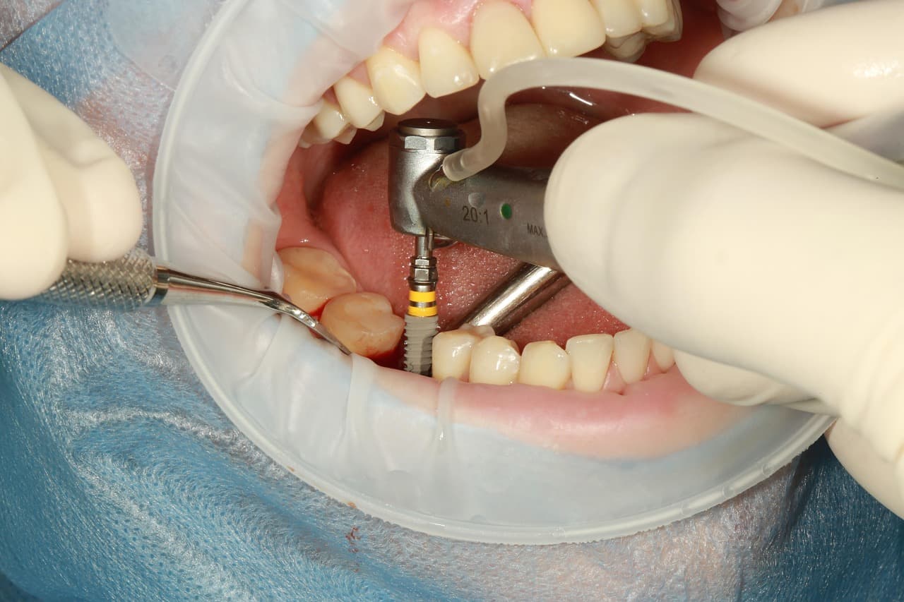Dental Implants vs. Bridges: How to Choose